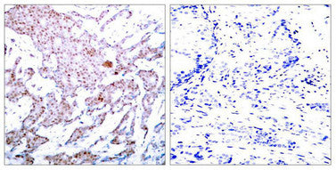 Immunohistochemical analysis of paraffin-embedded human breast carcinoma tissue using NFκB-p65 (Phospho-Ser536) Antibody (left) or the same antibody preincubated with blocking peptide (right).Rabbit anti-Human RELA Polyclonal Antibody