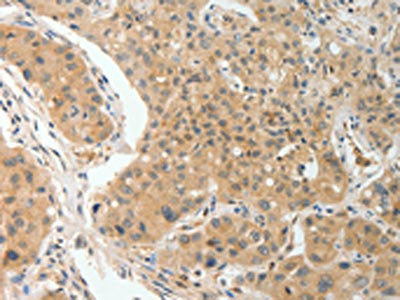 The image on the left is immunohistochemistry of paraffin-embedded Human lung cancer tissue using PRKCA Antibody(PRKCA Antibody) at dilution 1/10, on the right is treated with fusion protein. (Original magnification: ×200)Rabbit anti-Human PRKCA Polyclonal Antibody