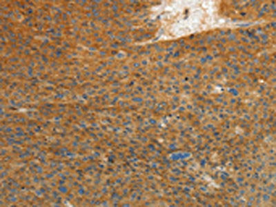 The image on the left is immunohistochemistry of paraffin-embedded Human liver cancer tissue using the antibody Antibody) at dilution 1/10, on the right is treated with fusion protein. (Original magnification: ×200)Rabbit anti-Human PRKCA Polyclonal Antibody