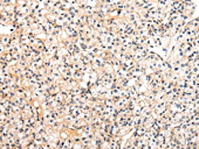 The image on the left is immunohistochemistry of paraffin-embedded Human prostate cancer tissue using VASH1 Antibody(VASH1 Antibody) at dilution 1/20, on the right is treated with fusion protein. (Original magnification: ×200)Rabbit anti-Human VASH1 Polyclonal Antibody