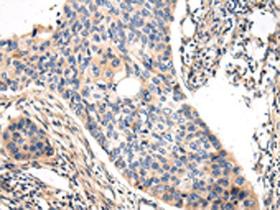 The image on the left is immunohistochemistry of paraffin-embedded Human esophagus cancer tissue using the antibody Antibody) at dilution 1/20, on the right is treated with fusion protein. (Original magnification: ×200)Rabbit anti-Human VASH1 Polyclonal Antibody