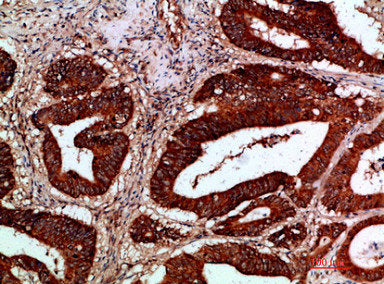 Immunohistochemical analysis of paraffin-embedded human-colon-cancer, antibody was diluted at 1:200Rabbit anti-Human IKBKG Polyclonal Antibody