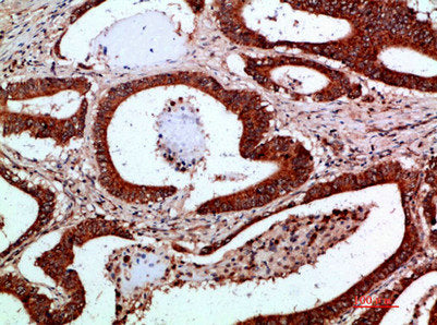 Immunohistochemical analysis of paraffin-embedded human-colon-cancer, antibody was diluted at 1:200Rabbit anti-Human IKBKG Polyclonal Antibody