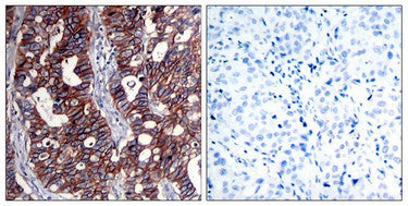 Immunohistochemical analysis of paraffin-embedded human breast carcinoma tissue using HER2(Ab-1221/1222) Antibody(left) or the same antibody preincubated with blocking peptide(right).Rabbit anti-Human ERBB2 Polyclonal Antibody