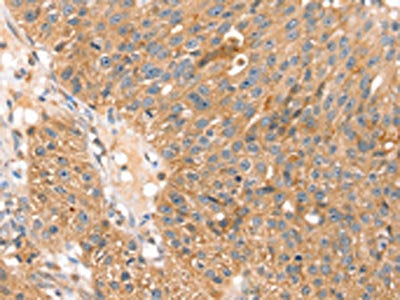 The image on the left is immunohistochemistry of paraffin-embedded Human breast cancer tissue using SOX11 Antibody(SOX11 Antibody) at dilution 1/20, on the right is treated with synthetic peptide. (Original magnification: ×200)Rabbit anti-Human SOX11 Polyclonal Antibody