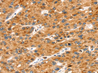 The image on the left is immunohistochemistry of paraffin-embedded Human liver cancer tissue using the antibody Antibody) at dilution 1/20, on the right is treated with synthetic peptide. (Original magnification: ×200)Rabbit anti-Human SOX11 Polyclonal Antibody