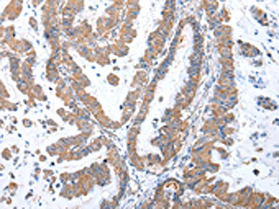 The image on the left is immunohistochemistry of paraffin-embedded Human esophagus cancer tissue using GRB14 Antibody(GRB14 Antibody) at dilution 1/35, on the right is treated with fusion protein. (Original magnification: ×200)Rabbit anti-Human GRB14 Polyclonal Antibody
