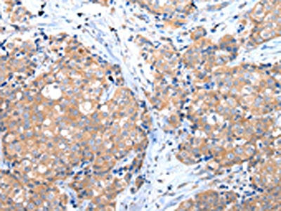 The image on the left is immunohistochemistry of paraffin-embedded Human breast cancer tissue using the antibody Antibody) at dilution 1/35, on the right is treated with fusion protein. (Original magnification: ×200)Rabbit anti-Human GRB14 Polyclonal Antibody