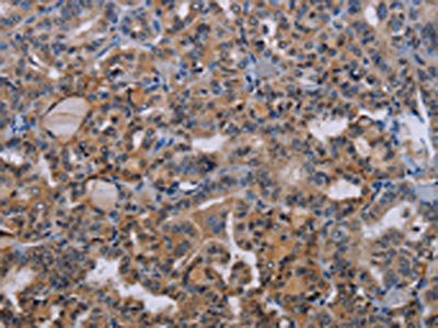 The image on the left is immunohistochemistry of paraffin-embedded Human thyroid cancer tissue using BMP3 Antibody(BMP3 Antibody) at dilution 1/20, on the right is treated with synthetic peptide. (Original magnification: ×200)