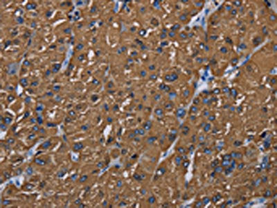 The image on the left is immunohistochemistry of paraffin-embedded Human liver cancer tissue using the antibody Antibody) at dilution 1/20, on the right is treated with synthetic peptide. (Original magnification: ×200)