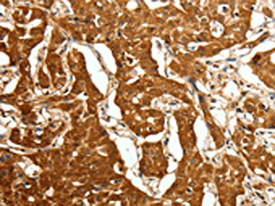 The image on the left is immunohistochemistry of paraffin-embedded Human lung cancer tissue using the antibody Antibody) at dilution 1/80, on the right is treated with fusion protein. (Original magnification: ×200)Rabbit anti-Human CDH23 Polyclonal Antibody