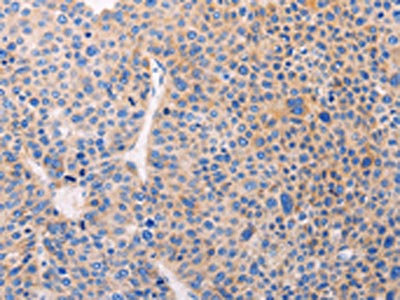 The image on the left is immunohistochemistry of paraffin-embedded Human liver cancer tissue using ADCY1 Antibody(ADCY1 Antibody) at dilution 1/60, on the right is treated with synthetic peptide. (Original magnification: ×200)Rabbit anti-Human ADCY1 Polyclonal Antibody