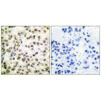 Immunohistochemical analysis of paraffin-embedded human breast carcinoma tissue using CREB-BP antibody.Rabbit anti-Human CREBBP Polyclonal Antibody