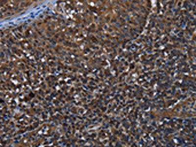 The image on the left is immunohistochemistry of paraffin-embedded Human tonsil tissue using the antibody Antibody) at dilution 1/30, on the right is treated with fusion protein. (Original magnification: ×200)Rabbit anti-Human GALT Polyclonal Antibody