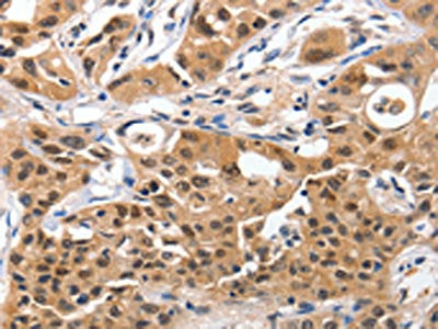 The image on the left is immunohistochemistry of paraffin-embedded Human lung cancer tissue using YWHAE Antibody(YWHAE Antibody) at dilution 1/100, on the right is treated with synthetic peptide. (Original magnification: ×200)Rabbit anti-Human YWHAE Polyclonal Antibody