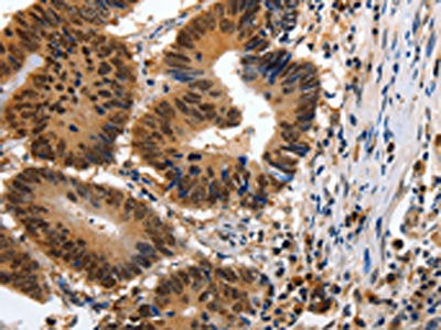 The image on the left is immunohistochemistry of paraffin-embedded Human colon cancer tissue using the antibody Antibody) at dilution 1/100, on the right is treated with synthetic peptide. (Original magnification: ×200)Rabbit anti-Human YWHAE Polyclonal Antibody