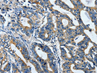 The image is immunohistochemistry of paraffin-embedded human gastric cancer tissue using TLR4 Antibody(TLR4 Antibody) at dilution 1/25. (Original magnification: ×200)Rabbit anti-Human TLR4 Polyclonal Antibody