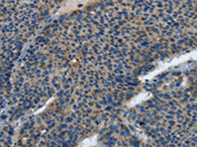 The image is immunohistochemistry of paraffin-embedded human liver cancer tissue using the antibody Antibody) at dilution 1/25. (Original magnification: ×200)Rabbit anti-Human TLR4 Polyclonal Antibody