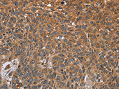 The image on the left is immunohistochemistry of paraffin-embedded Human lung cancer tissue using GH2 Antibody(GH2 Antibody) at dilution 1/40, on the right is treated with fusion protein. (Original magnification: ×200)Rabbit anti-Human GH2 Polyclonal Antibody