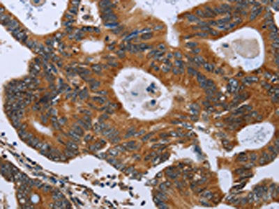 The image on the left is immunohistochemistry of paraffin-embedded Human colon cancer tissue using the antibody Antibody) at dilution 1/40, on the right is treated with fusion protein. (Original magnification: ×200)Rabbit anti-Human GH2 Polyclonal Antibody