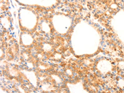 The image on the left is immunohistochemistry of paraffin-embedded Human thyroid cancer tissue using NAP1L1 Antibody(NAP1L1 Antibody) at dilution 1/70, on the right is treated with fusion protein. (Original magnification: ×200)Rabbit anti-Human NAP1L1 Polyclonal Antibody
