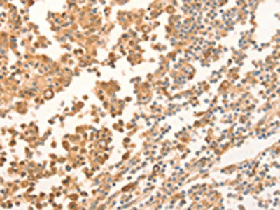 The image on the left is immunohistochemistry of paraffin-embedded Human tonsil tissue using the antibody Antibody) at dilution 1/70, on the right is treated with fusion protein. (Original magnification: ×200)Rabbit anti-Human NAP1L1 Polyclonal Antibody