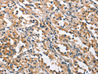 The image on the left is immunohistochemistry of paraffin-embedded Human thyroid cancer tissue using CHMP1A Antibody(CHMP1A Antibody) at dilution 1/60, on the right is treated with fusion protein. (Original magnification: ×200)