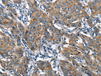 The image on the left is immunohistochemistry of paraffin-embedded Human gastic cancer tissue using the antibody Antibody) at dilution 1/60, on the right is treated with fusion protein. (Original magnification: ×200)