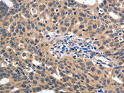 The image on the left is immunohistochemistry of paraffin-embedded Human ovarian cancer tissue using YWHAE Antibody(YWHAE Antibody) at dilution 1/60, on the right is treated with synthetic peptide. (Original magnification: ×200)Rabbit anti-Human YWHAE Polyclonal Antibody