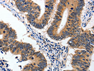 The image on the left is immunohistochemistry of paraffin-embedded Human colon cancer tissue using the antibody Antibody) at dilution 1/60, on the right is treated with synthetic peptide. (Original magnification: ×200)Rabbit anti-Human YWHAE Polyclonal Antibody