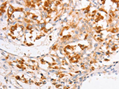 The image on the left is immunohistochemistry of paraffin-embedded Human thyroid cancer tissue using YARS2 Antibody(YARS2 Antibody) at dilution 1/20, on the right is treated with fusion protein. (Original magnification: ×200)Rabbit anti-Human YARS2 Polyclonal Antibody