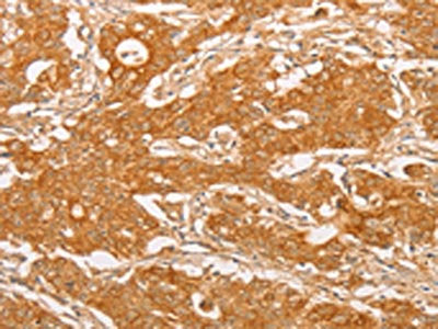 The image on the left is immunohistochemistry of paraffin-embedded Human gastic cancer tissue using the antibody Antibody) at dilution 1/20, on the right is treated with fusion protein. (Original magnification: ×200)Rabbit anti-Human YARS2 Polyclonal Antibody