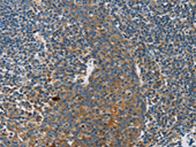 The image on the left is immunohistochemistry of paraffin-embedded Human tonsil tissue using the antibody Antibody) at dilution 1/30, on the right is treated with fusion protein. (Original magnification: ×200)