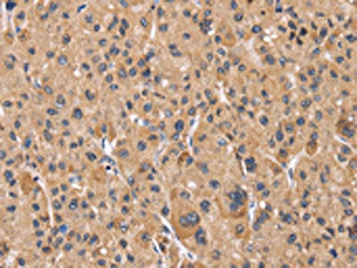 The image on the left is immunohistochemistry of paraffin-embedded Human liver cancer tissue using PPIF Antibody(PPIF Antibody) at dilution 1/60, on the right is treated with fusion protein. (Original magnification: ×200)Rabbit anti-Human PPIF Polyclonal Antibody