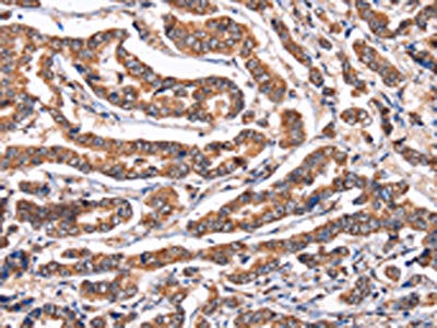 The image on the left is immunohistochemistry of paraffin-embedded Human breast cancer tissue using the antibody Antibody) at dilution 1/60, on the right is treated with fusion protein. (Original magnification: ×200)Rabbit anti-Human PPIF Polyclonal Antibody