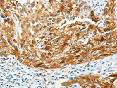 The image on the left is immunohistochemistry of paraffin-embedded Human esophagus cancer tissue using MAF Antibody(MAF Antibody) at dilution 1/50, on the right is treated with synthetic peptide. (Original magnification: ×200)