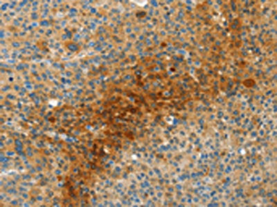 The image on the left is immunohistochemistry of paraffin-embedded Human liver cancer tissue using the antibody Antibody) at dilution 1/50, on the right is treated with synthetic peptide. (Original magnification: ×200)