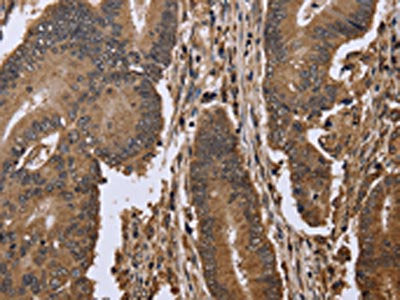The image on the left is immunohistochemistry of paraffin-embedded Human colon cancer tissue using the antibody Antibody) at dilution 1/50, on the right is treated with fusion protein. (Original magnification: ×200)Rabbit anti-Human EIF3H Polyclonal Antibody