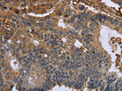 The image on the left is immunohistochemistry of paraffin-embedded Human colon cancer tissue using the antibody Antibody) at dilution 1/50, on the right is treated with fusion protein. (Original magnification: ×200)Rabbit anti-Human FLNA Polyclonal Antibody