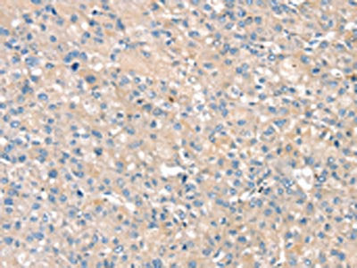 The image on the left is immunohistochemistry of paraffin-embedded Human liver cancer tissue using the antibody Antibody) at dilution 1/25, on the right is treated with fusion protein. (Original magnification: ×200)Rabbit anti-Human PIN1 Polyclonal Antibody