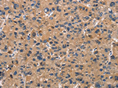 The image on the left is immunohistochemistry of paraffin-embedded Human liver cancer tissue using ATP7A Antibody(ATP7A  Antibody) at dilution 1/50, on the right is treated with synthetic peptide. (Original magnification: ×200)