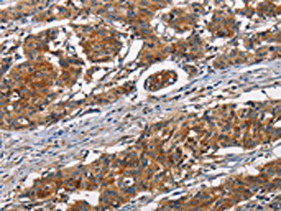 The image on the left is immunohistochemistry of paraffin-embedded Human gastic cancer tissue using the antibody  Antibody) at dilution 1/50, on the right is treated with synthetic peptide. (Original magnification: ×200)