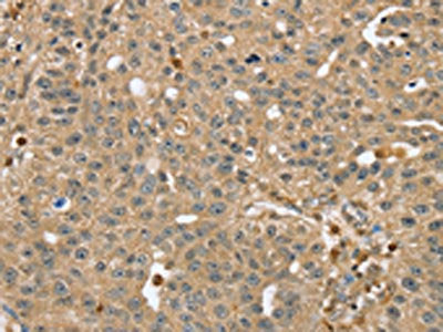 The image on the left is immunohistochemistry of paraffin-embedded Human breast cancer tissue using the antibody Antibody) at dilution 1/40, on the right is treated with fusion protein. (Original magnification: ×200)Rabbit anti-Human RNH1 Polyclonal Antibody