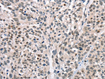The image on the left is immunohistochemistry of paraffin-embedded Human esophagus cancer tissue using CABLES1 Antibody(CABLES1 Antibody) at dilution 1/15, on the right is treated with fusion protein. (Original magnification: ×200)