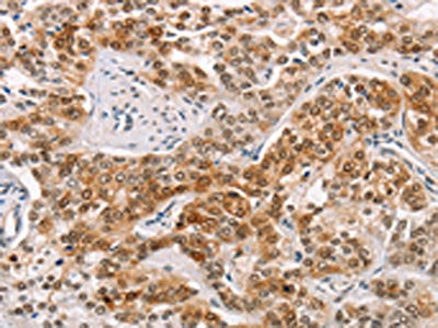 The image on the left is immunohistochemistry of paraffin-embedded Human prostate cancer tissue using the antibody Antibody) at dilution 1/15, on the right is treated with fusion protein. (Original magnification: ×200)