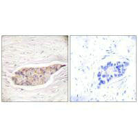 Immunohistochemical analysis of paraffin-embedded human breast carcinoma tissue using Annexin A6 antibody.Rabbit anti-Human ANXA6 Polyclonal Antibody
