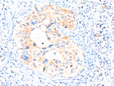 The image on the left is immunohistochemistry of paraffin-embedded Human cervical cancer tissue using AIMP2 Antibody(AIMP2 Antibody) at dilution 1/25, on the right is treated with synthetic peptide. (Original magnification: ×200)Rabbit anti-Human AIMP2 Polyclonal Antibody