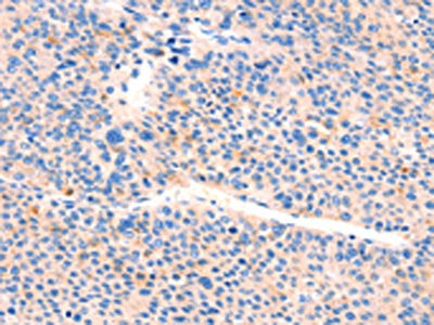 The image on the left is immunohistochemistry of paraffin-embedded Human liver cancer tissue using the antibody Antibody) at dilution 1/25, on the right is treated with synthetic peptide. (Original magnification: ×200)Rabbit anti-Human AIMP2 Polyclonal Antibody