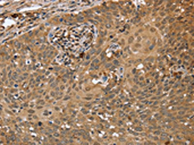 The image on the left is immunohistochemistry of paraffin-embedded Human cervical cancer tissue using NMT1 Antibody(NMT1 Antibody) at dilution 1/45, on the right is treated with synthetic peptide. (Original magnification: ×200)Rabbit anti-Human NMT1 Polyclonal Antibody