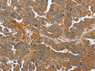 The image on the left is immunohistochemistry of paraffin-embedded Human ovarian cancer tissue using the antibody Antibody) at dilution 1/45, on the right is treated with synthetic peptide. (Original magnification: ×200)Rabbit anti-Human NMT1 Polyclonal Antibody